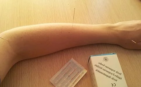 针灸止痛的科学原理有哪些