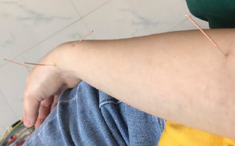 针灸减肥的注意事项